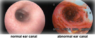 normal & abnormal ear canal normal & abnormal ear canal